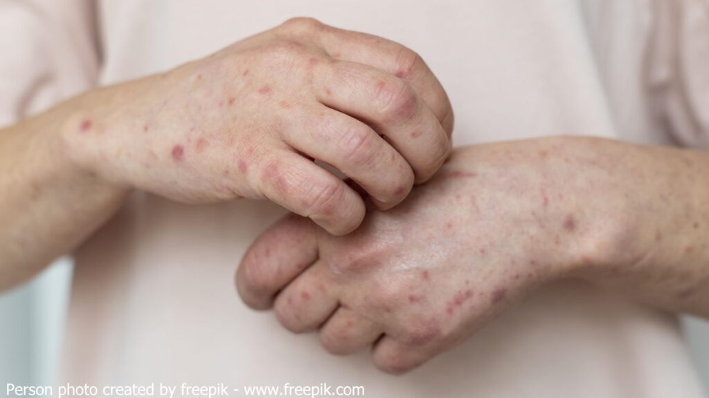 พาว ผิวหนัง ผื่นคัน