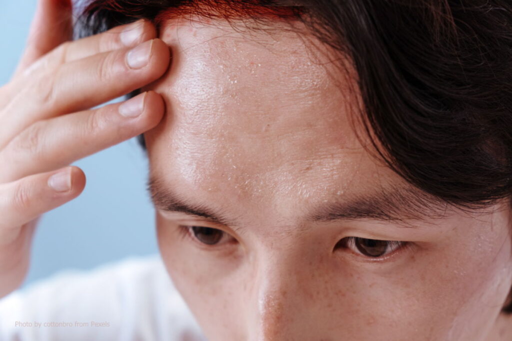 พาว ภูมิแพ้ แพ้เหงื่อ