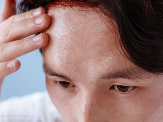 พาว ภูมิแพ้ แพ้เหงื่อ